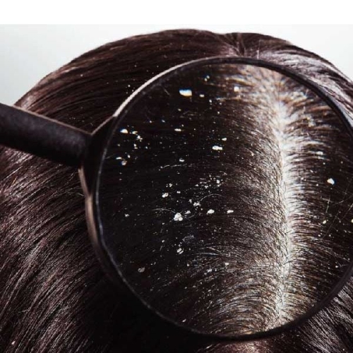 BỊ BỆNH GÀU NÊN ĂN GÌ ĐỂ NHANH HẾT GÀU?